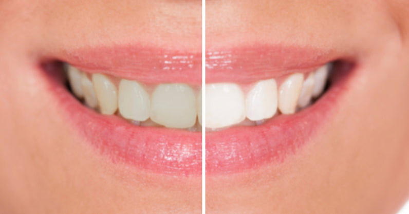5 Ways to Whiten Your Teeth