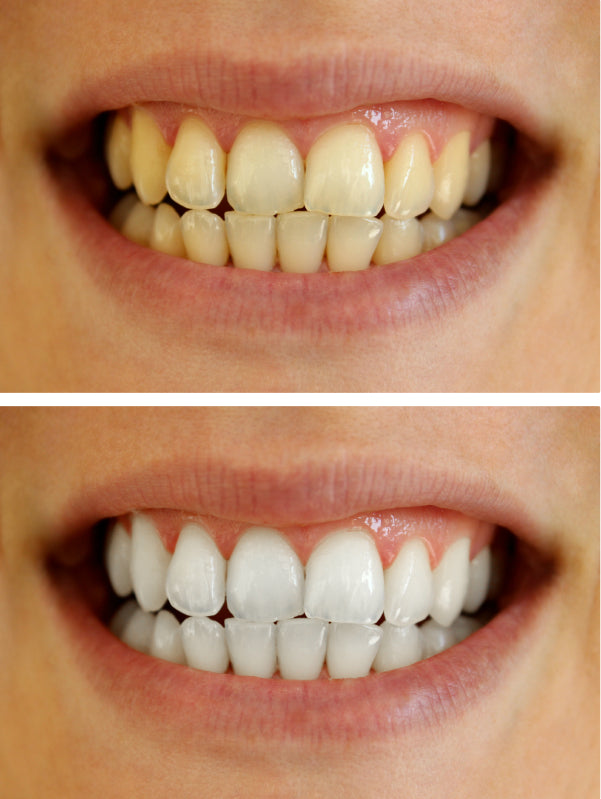 Teeth Whitening Before and After